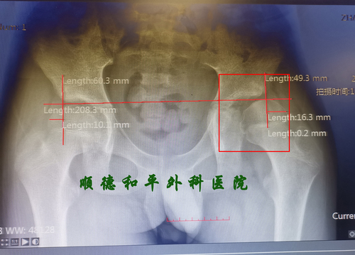 X光术前.jpg