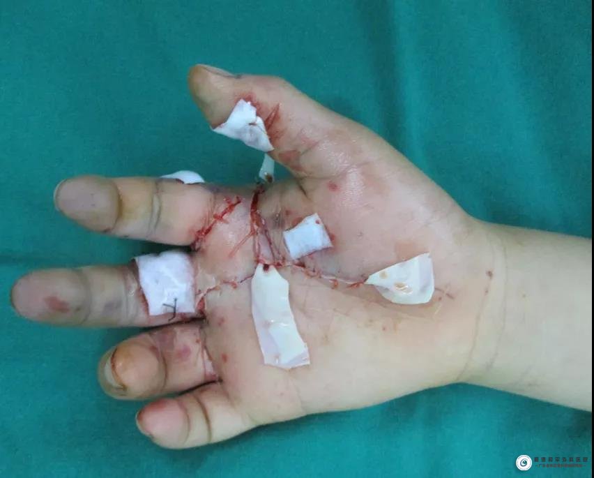 6岁男童玩"雷",手掌被严重炸伤